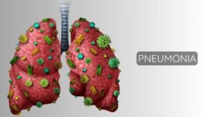 pnuemonia-dr-swapnil-gauatm