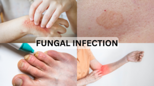 fungal_infections