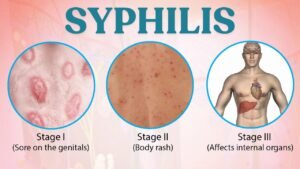 syphilis-specialist-swapnil-gauatam