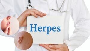 herpes-treatment-in-mumbai
