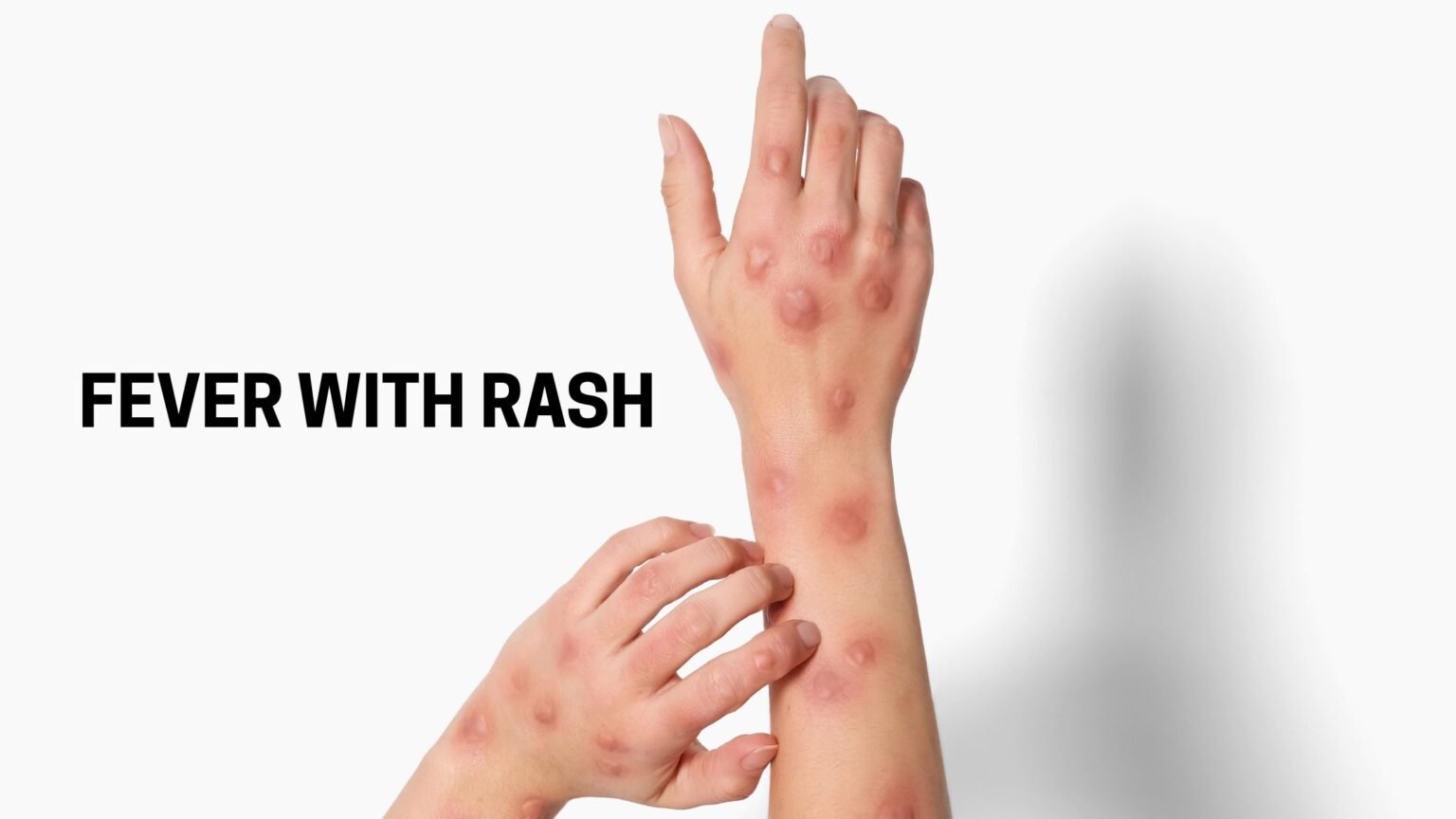 Fever with Rash: Causes, Symptoms & When to See a Doctor - Dr Swapnil ...